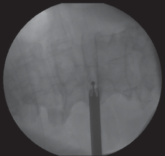 Usage of an endoscopic burr under fluoroscopic guidance to resect the superior articular process.