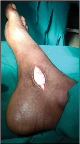 Clinical image showing the oblique incision over the prominent navicular bone.