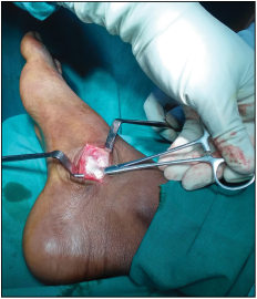 Clinical image showing the delineated tibialis posterior tendon.