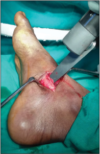 Intraoperative picture showing flip osteotomy of the navicular with tendon of tibialis posterior attached to it.