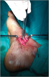 Intraoperative picture showing resection of prominent portion of navicular after flip osteotomy.