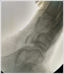 Intraoperative fluoroscopic image showing resection of prominent portion of navicular after flip osteotomy.