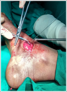 Intraoperative picture showing anchoring of flake of bone with tendon of tibialis posterior attached to the navicular bone.