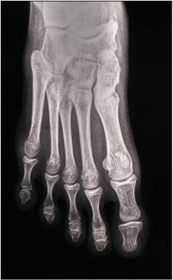 Postoperative radiograph anteroposterior view of right foot at one year follow up showing union of the osteotomy.