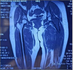 MRI of the pelvis with both hips showing hypointense signals on T1 and hyperintense signals on T2 sequence respectively.