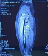 MRI of the pelvis with both hips showing hypointense signals on T1 and hyperintense signals on T2 sequence respectively.