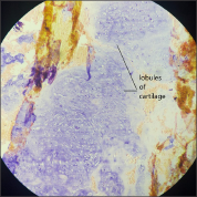 Histopathology specimen showing lobules of cartilage. (Hematoxylin and eosin, 10X)