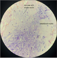 Histopathology showing chondroid matrix and lacunae with single nuclei. (Hematoxylin and eosin, 10X)