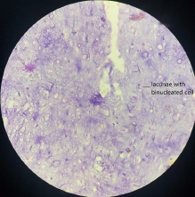 Histopathology showing lacunae with binucleated cells. (Hematoxylin and eosin, 10X)