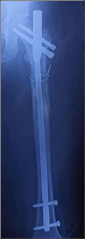 Anteroposterior view of left femur x-ray at six months follow up