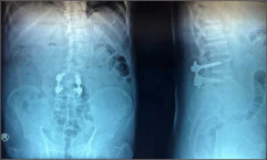 Postoperative X-ray shows TLIF L4–L5. TLIF: Transforaminal lumbar interbody fusion