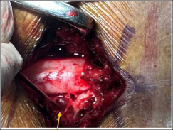 Intraoperative picture showing engorged epidural vein on left side marked by an arrow.