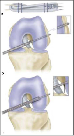 (a) Quadruple hamstring graft technique. (b) Graft preparation [Quadreupled Hamstring graft with whip stitches (so that the interference screw doesn't cut out the graft) in the proximal and distal part]. (c) Femoral socket drilling using femoral offset guide.