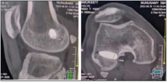 Three-year follow-up computed tomography (CT) showing femoral canal diameter for interference screw.