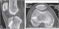 Three-year follow-up computed tomography (CT) showing femoral canal diameter for Endo button. A modified Lemmair technique has also been used.