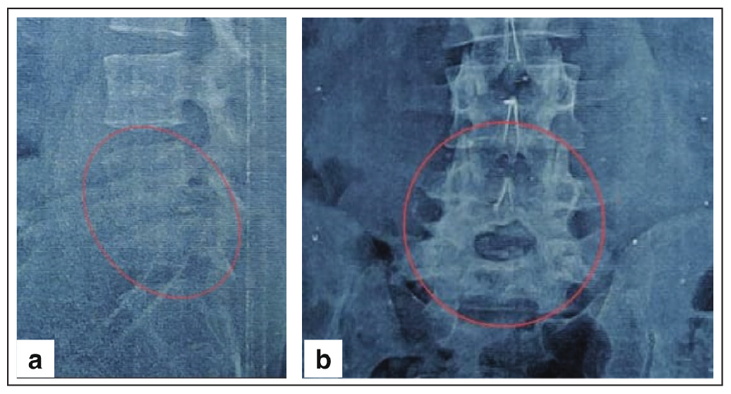 Pre-operative (a) lateral–shows reduce disc space and (b) anteroposterior (AP)–arthropathy. Disc space reduction shown with red circle in x-ray.