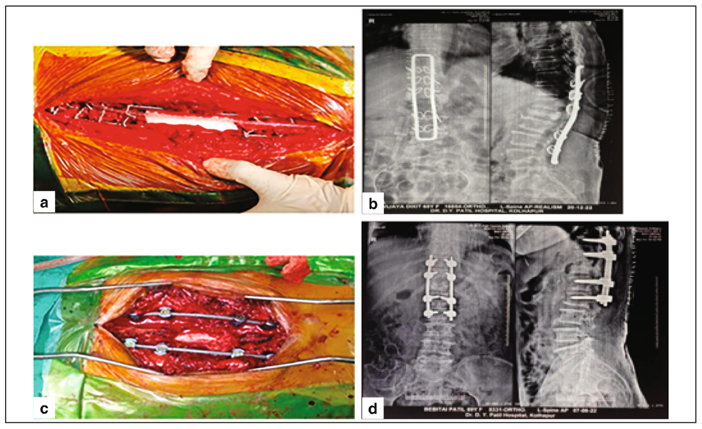 (a) Hartshill fixation intraop image. (b) Intraop pedicel screw fixation. (c) Post op pedical screw fixation. (d) Post op hartshill fixation.