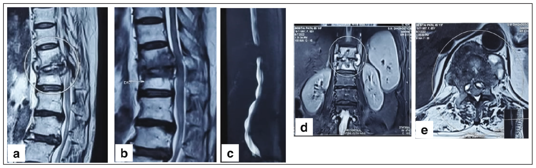 (a) Saggital T2, (b) Saggital T1, (c) Mylogram, (d) Coronal cut and (e) Axial cut. Pott’s disease-related pan vertebral involvement of the D12 vertebra and pedicle degradation are visible in the magnetic resonance imaging (MRI) of a 69-year-old female patient (circle).