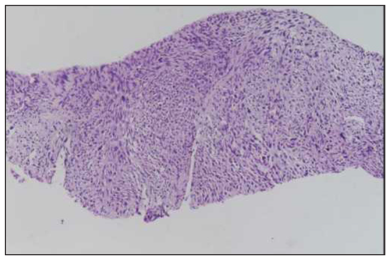 20×. tiff section of tumour showing malignant cells with anisonucleosis and plomorphism. (Hematoxylin and eosin stain)