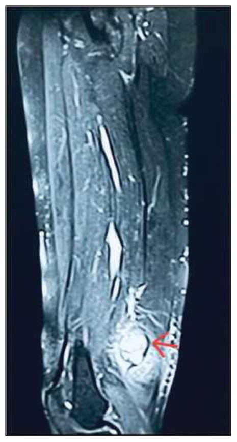 CE MRI of right thigh showing a soft tissues mass of 9.5 × 4.5 × 3.5 cm (red arrow).