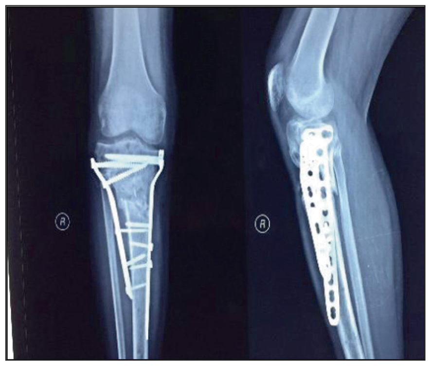SSI Surgical Site Infection.