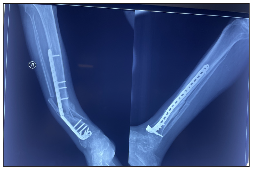 Exposed Perforating Implant.