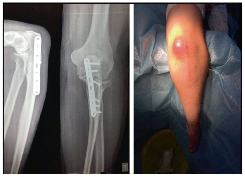 Bursitis.
