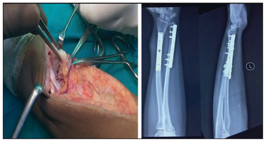 Tenosynovitis with Screw Impingement.