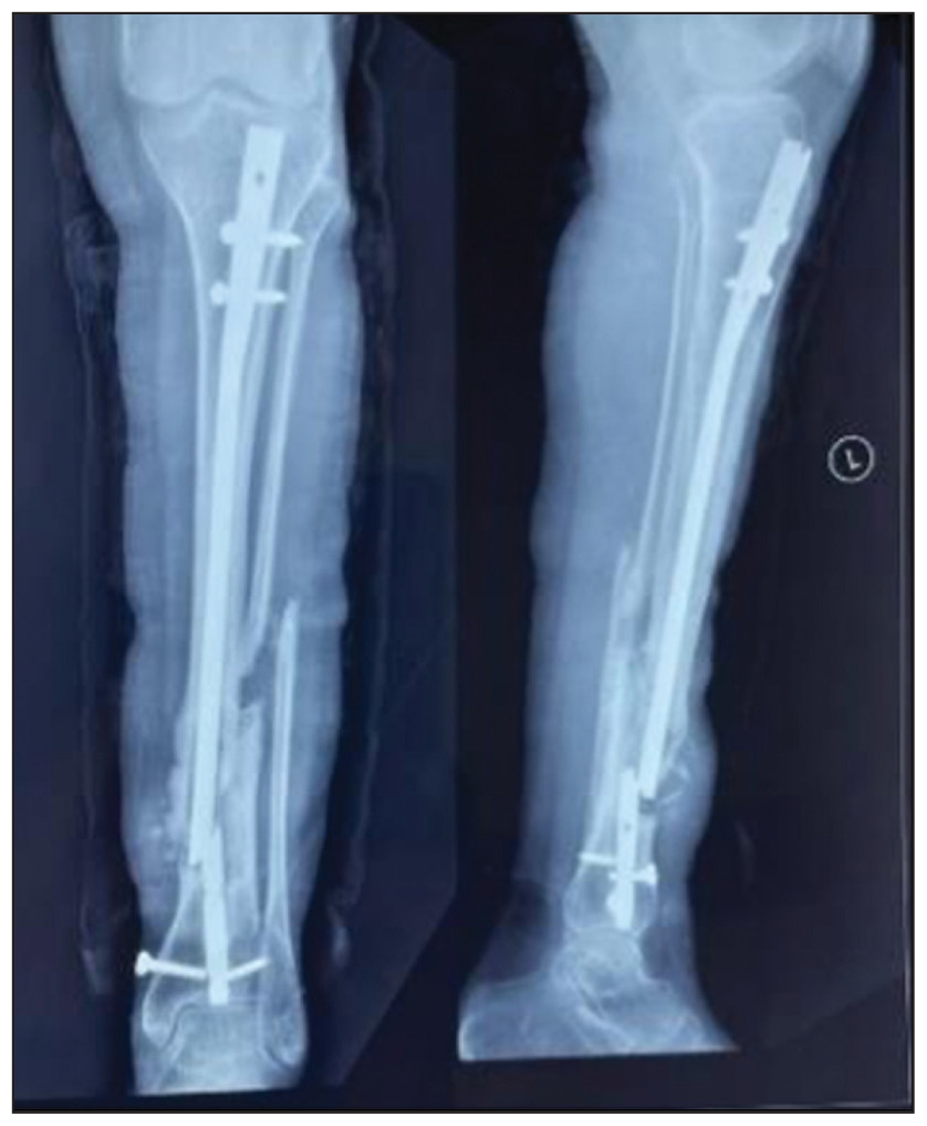 Broken Implant with Nonunion.