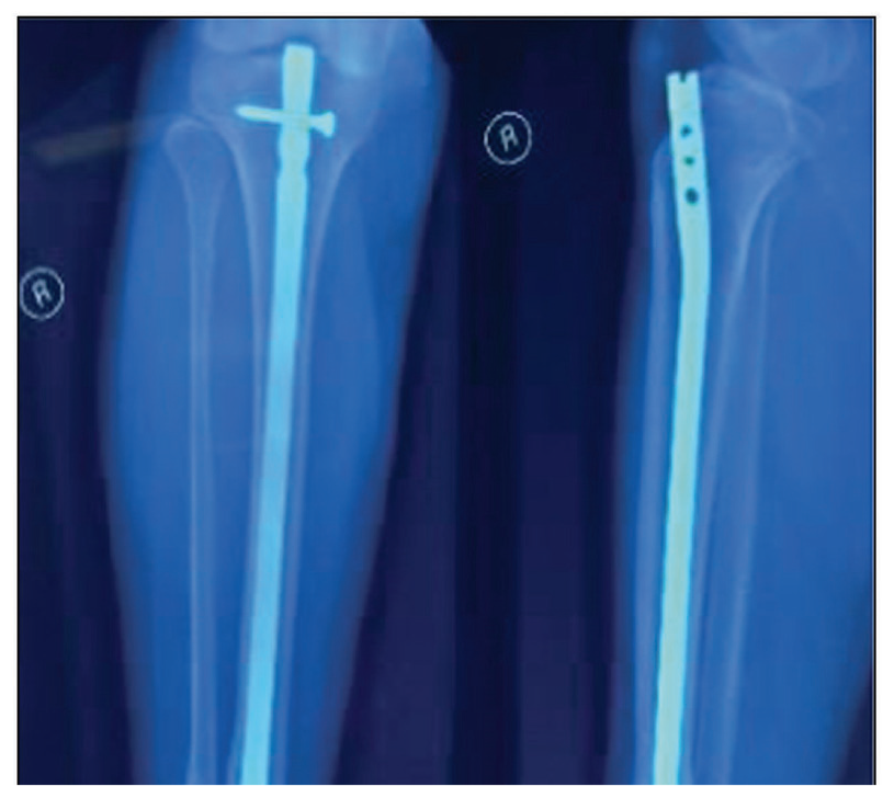 Intra Articular Metal.