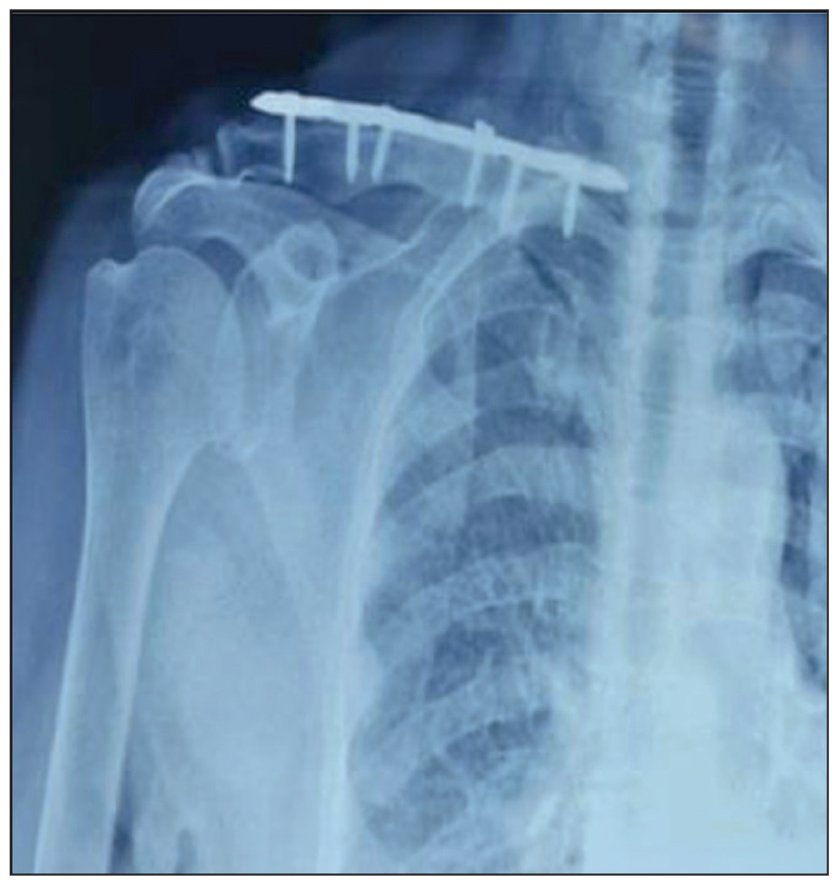 Impairment of Function.
